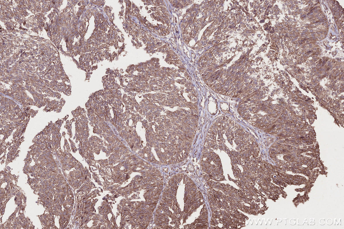 Immunohistochemical analysis of paraffin-embedded human ovary cancer tissue slide using KHC2687 (LSM14A IHC Kit).