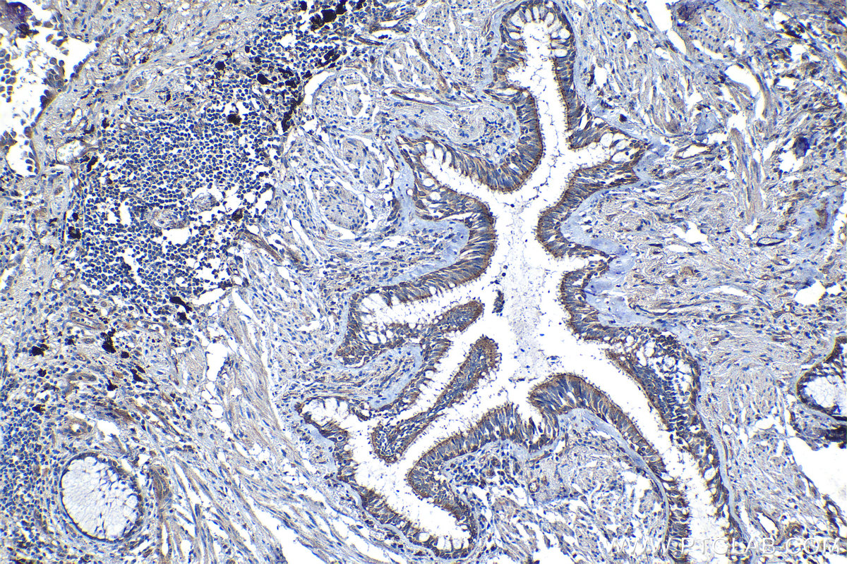 Immunohistochemical analysis of paraffin-embedded human lung cancer tissue slide using KHC1249 (LUZP1 IHC Kit).