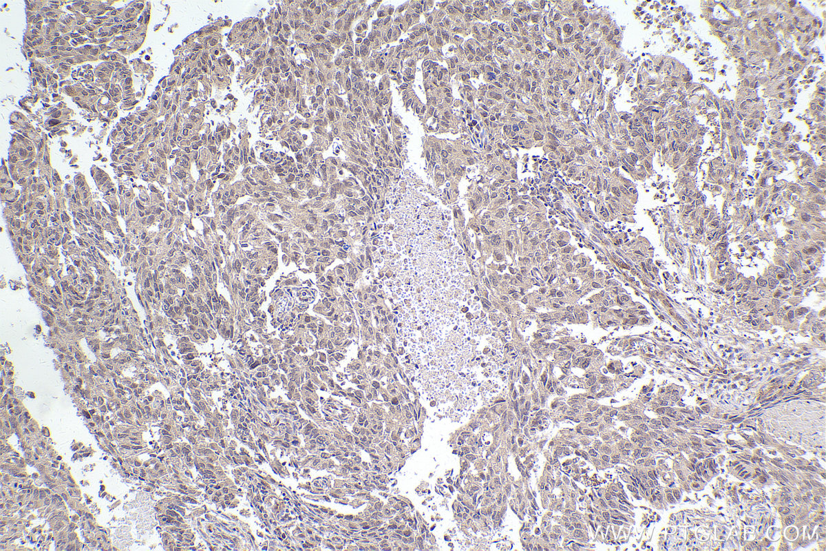 Immunohistochemical analysis of paraffin-embedded human lung cancer tissue slide using KHC2476 (MAD2L1BP IHC Kit).