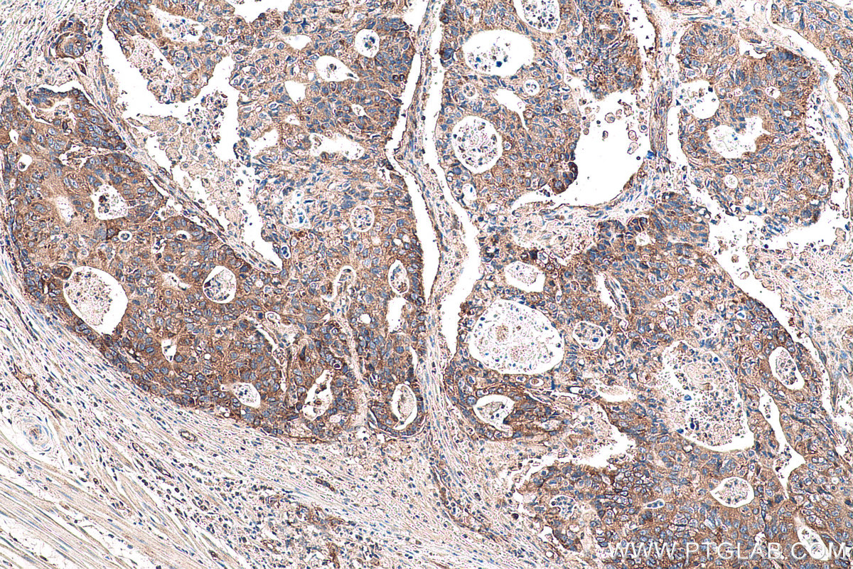 Immunohistochemical analysis of paraffin-embedded human stomach cancer tissue slide using KHC0948 (MARCKSL1 IHC Kit).