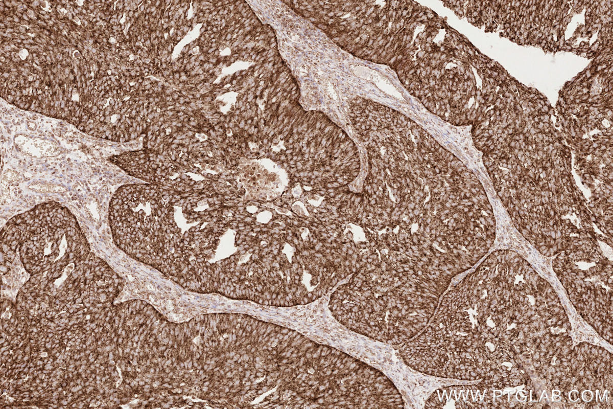 Immunohistochemical analysis of paraffin-embedded human ovary cancer tissue slide using KHC2620 (MAVS IHC Kit).