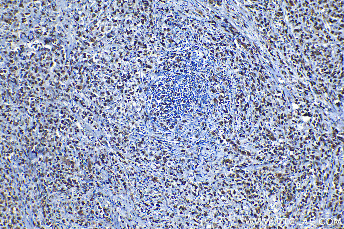 Immunohistochemical analysis of paraffin-embedded human lymphoma tissue slide using KHC1324 (MCM7 IHC Kit).