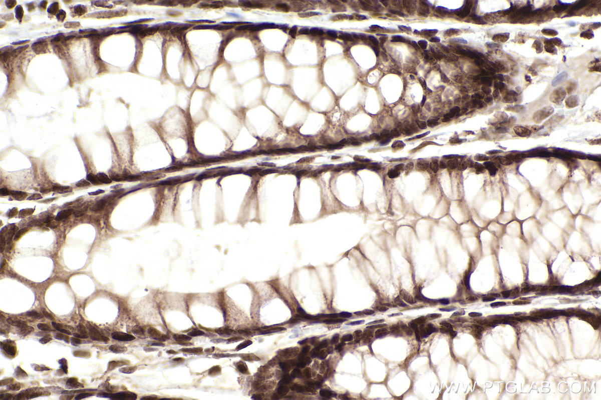 Immunohistochemical analysis of paraffin-embedded human rectal cancer tissue slide using KHC2462 (MDC1 IHC Kit).