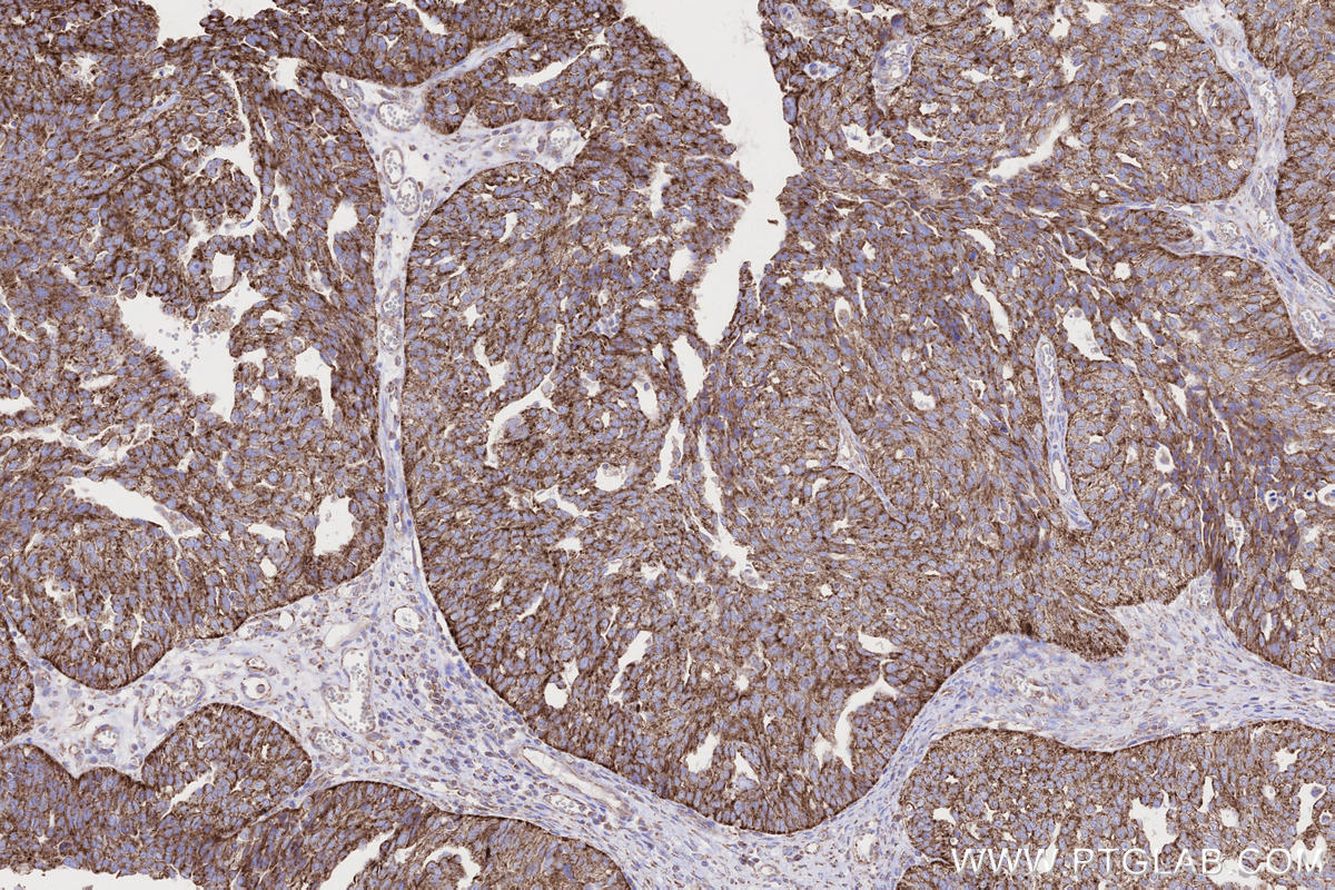 Immunohistochemical analysis of paraffin-embedded human ovary cancer tissue slide using KHC2650 (MFN1 IHC Kit).