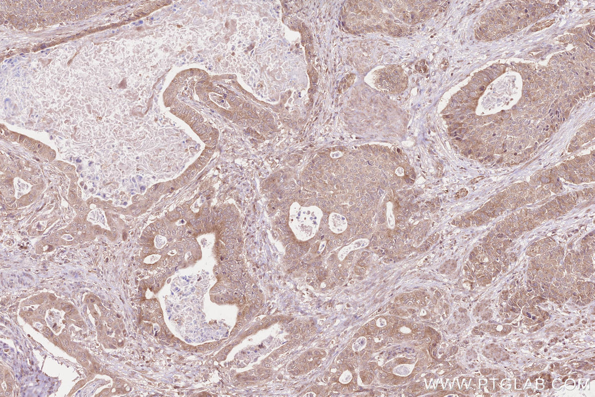 Immunohistochemical analysis of paraffin-embedded human stomach cancer tissue slide using KHC2558 (MLK4 IHC Kit).