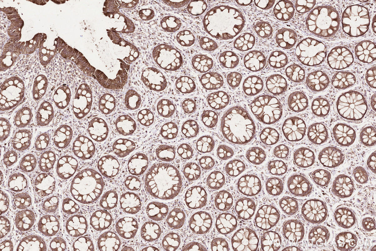 Immunohistochemical analysis of paraffin-embedded human rectal cancer tissue slide using KHC2527 (MPEG1 IHC Kit).