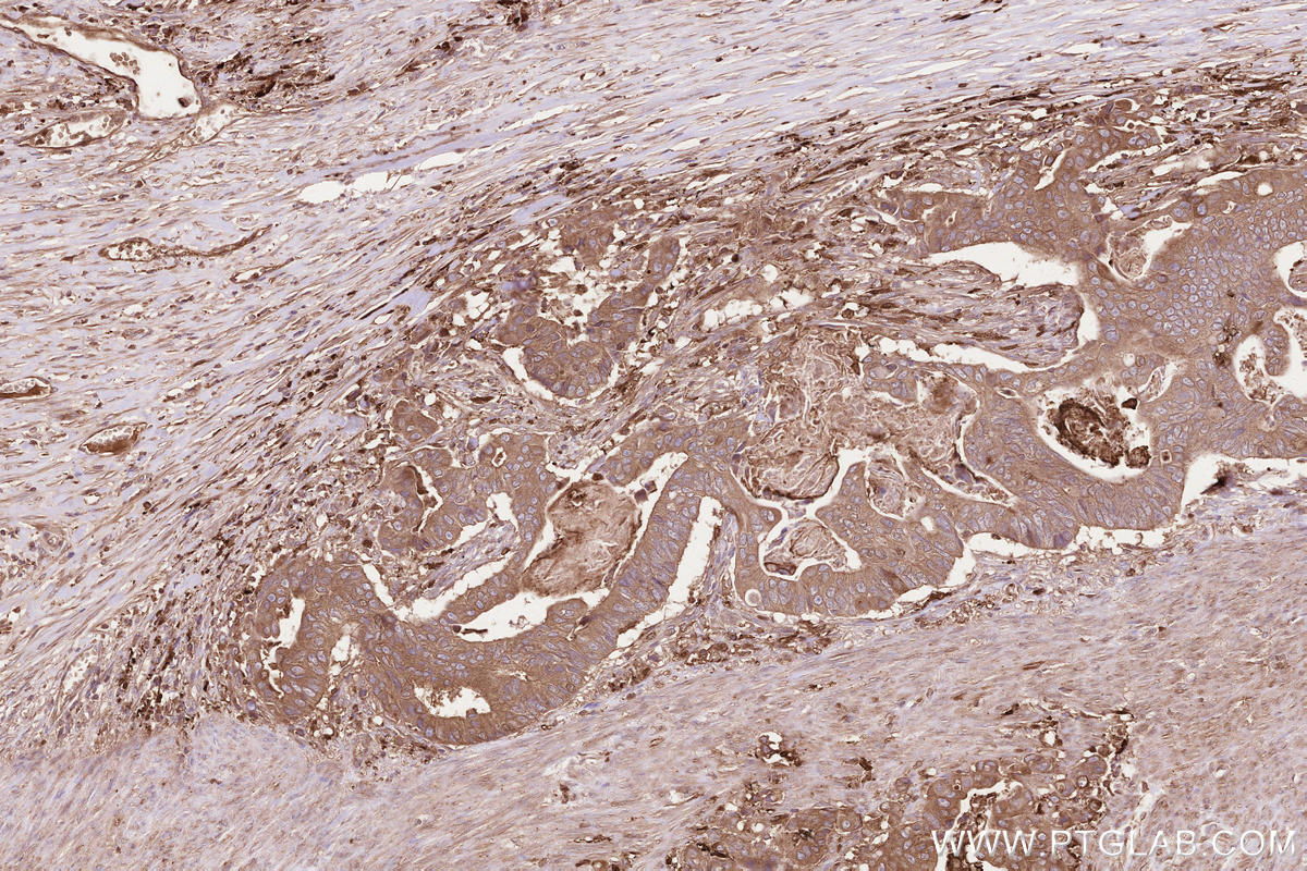 Immunohistochemical analysis of paraffin-embedded human stomach cancer tissue slide using KHC2598 (MPRIP IHC Kit).