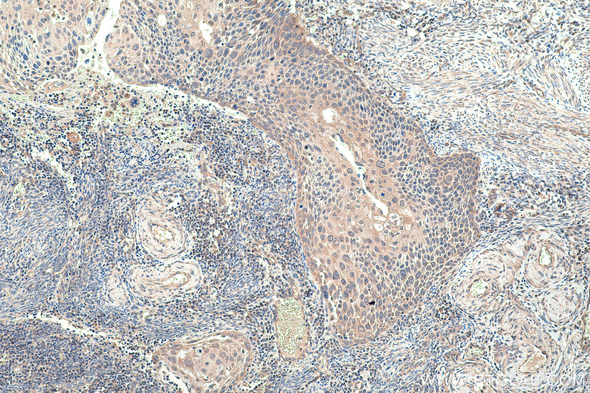 Immunohistochemical analysis of paraffin-embedded human cervical cancer tissue slide using KHC0367 (MYO1B IHC Kit).