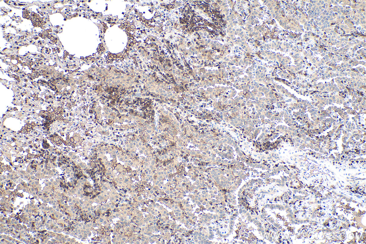 Immunohistochemical analysis of paraffin-embedded human lung cancer tissue slide using KHC0368 (MYO1G IHC Kit).