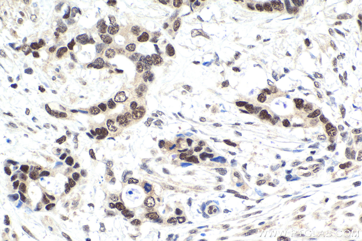 Immunohistochemical analysis of paraffin-embedded human urothelial carcinoma tissue slide using KHC1882 (NACC1 IHC Kit).