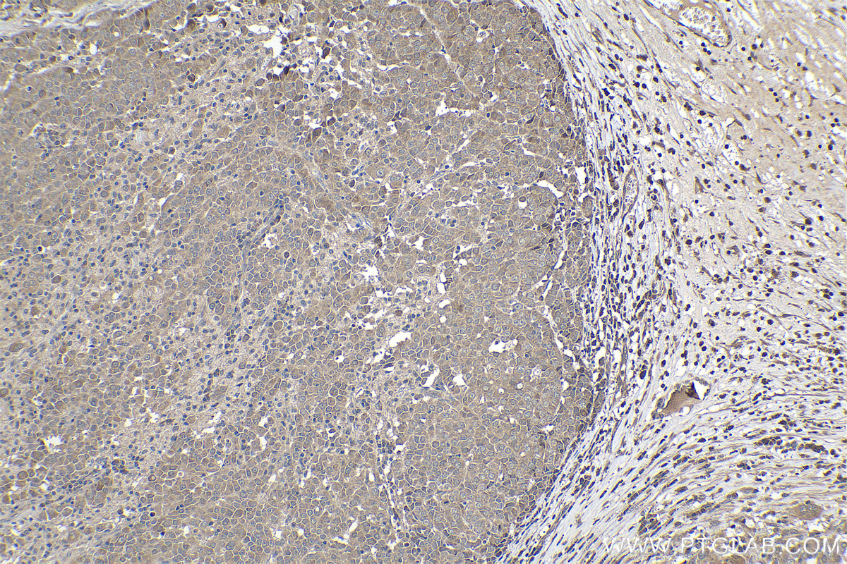 Immunohistochemical analysis of paraffin-embedded human ovary tumor tissue slide using KHC1062 (NOTCH2 IHC Kit).