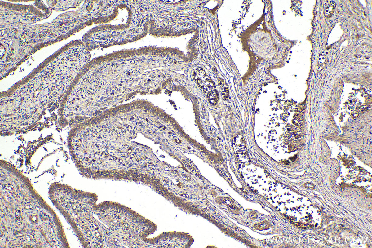 Immunohistochemical analysis of paraffin-embedded human ovary tumor tissue slide using KHC2200 (NCF2 IHC Kit).