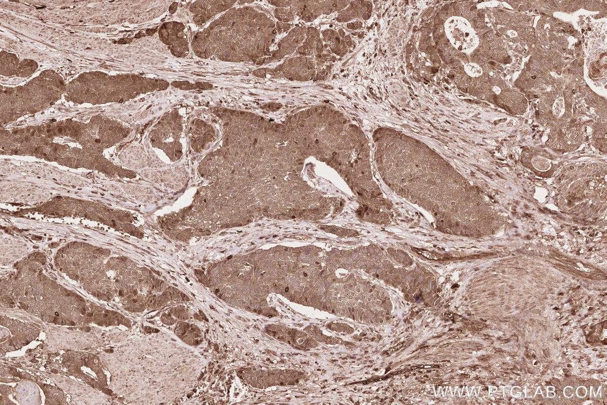 Immunohistochemical analysis of paraffin-embedded human stomach cancer tissue slide using KHC2621 (NPHP3 IHC Kit).