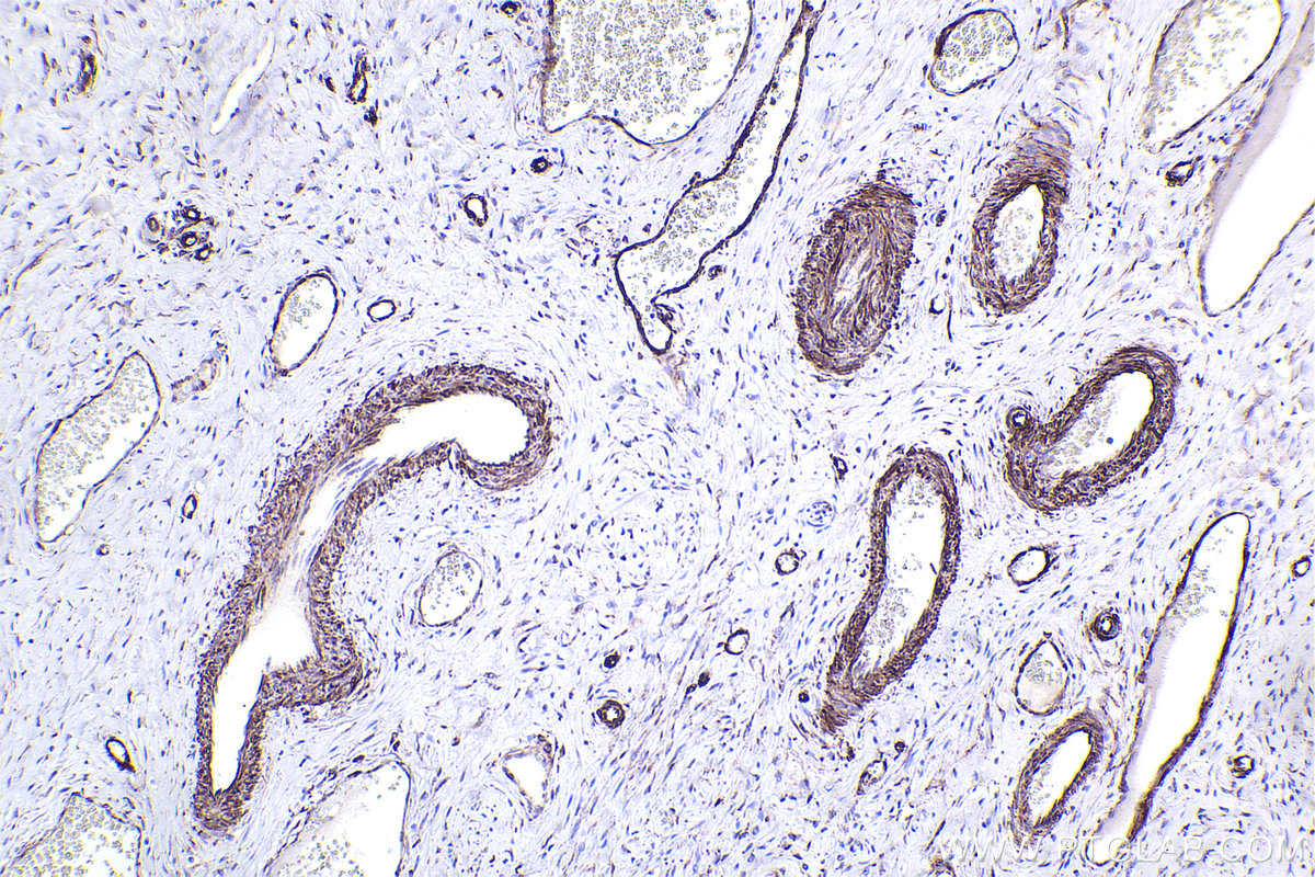 Immunohistochemical analysis of paraffin-embedded human cervical cancer tissue slide using KHC2283 (Nestin IHC Kit).