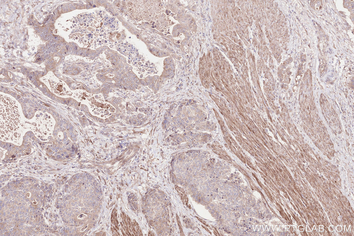 Immunohistochemical analysis of paraffin-embedded human stomach cancer tissue slide using KHC2561 (OBSCN IHC Kit).