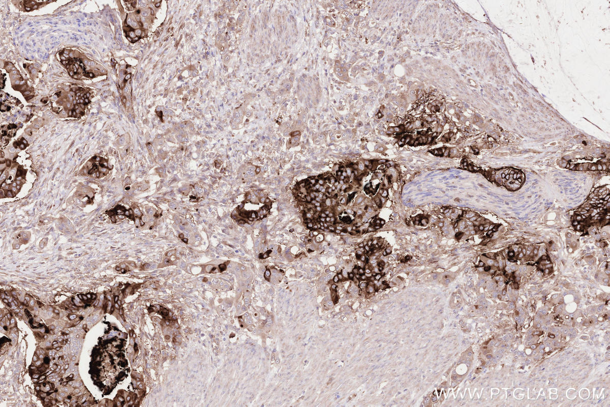 Immunohistochemical analysis of paraffin-embedded human stomach cancer tissue slide using KHC2597 (OLFM4 IHC Kit).