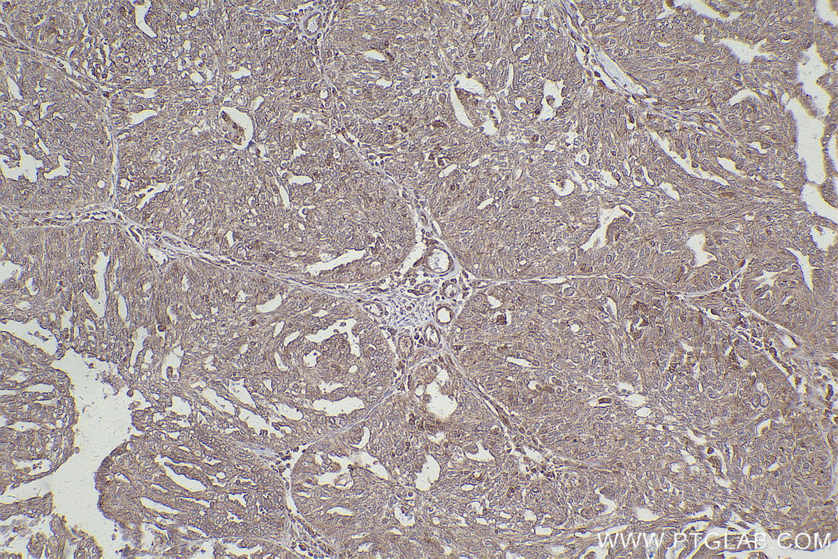 Immunohistochemical analysis of paraffin-embedded human ovary cancer tissue slide using KHC2420 (PAK2 IHC Kit).