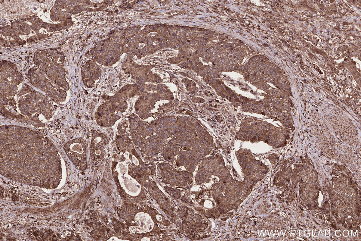 Immunohistochemical analysis of paraffin-embedded human stomach cancer tissue slide using KHC2688 (PAPD5 IHC Kit).