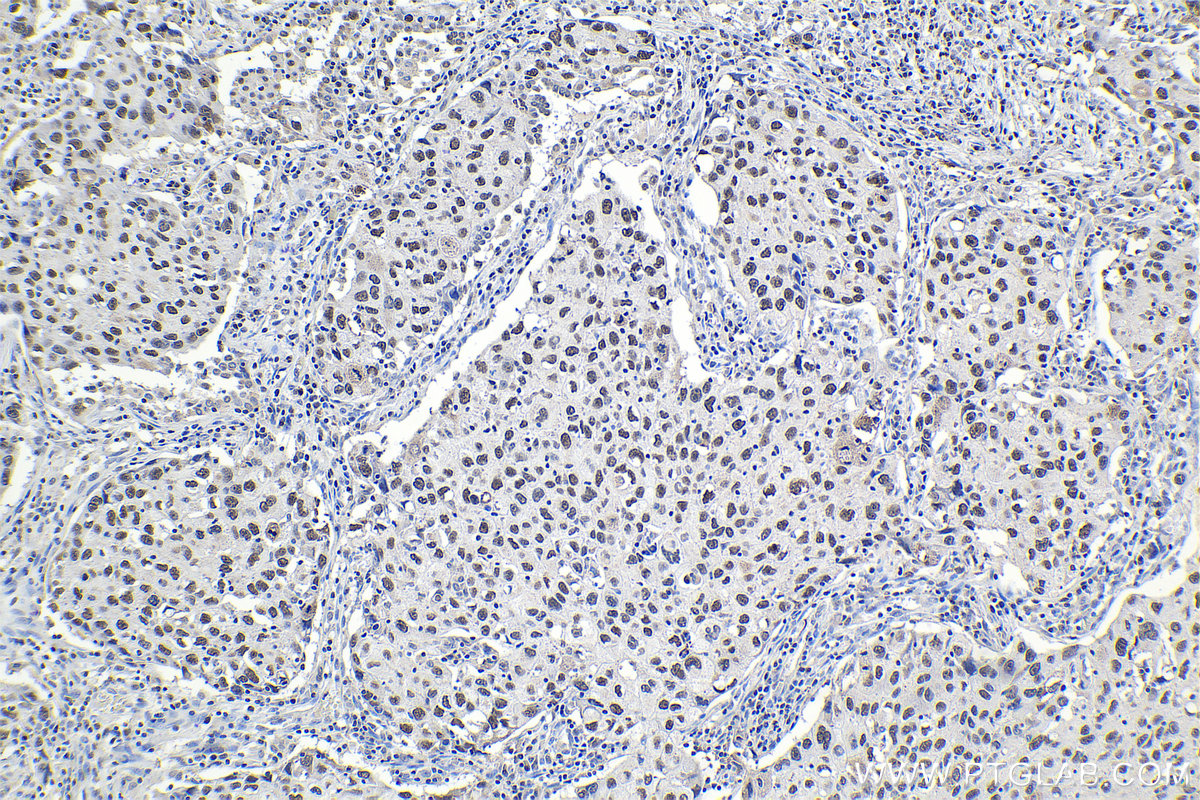 Immunohistochemical analysis of paraffin-embedded human lung cancer tissue slide using KHC1069 (PARP1 IHC Kit).