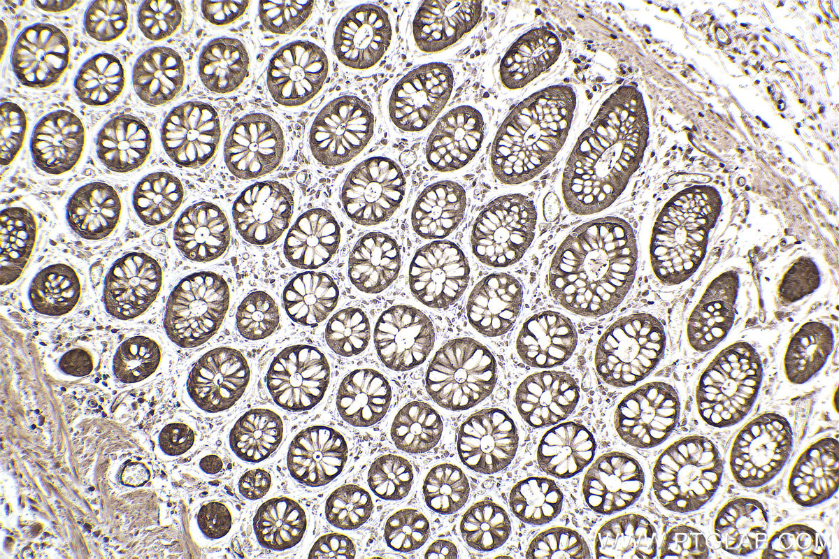 Immunohistochemical analysis of paraffin-embedded human rectal cancer tissue slide using KHC2532 (PDCD4 IHC Kit).