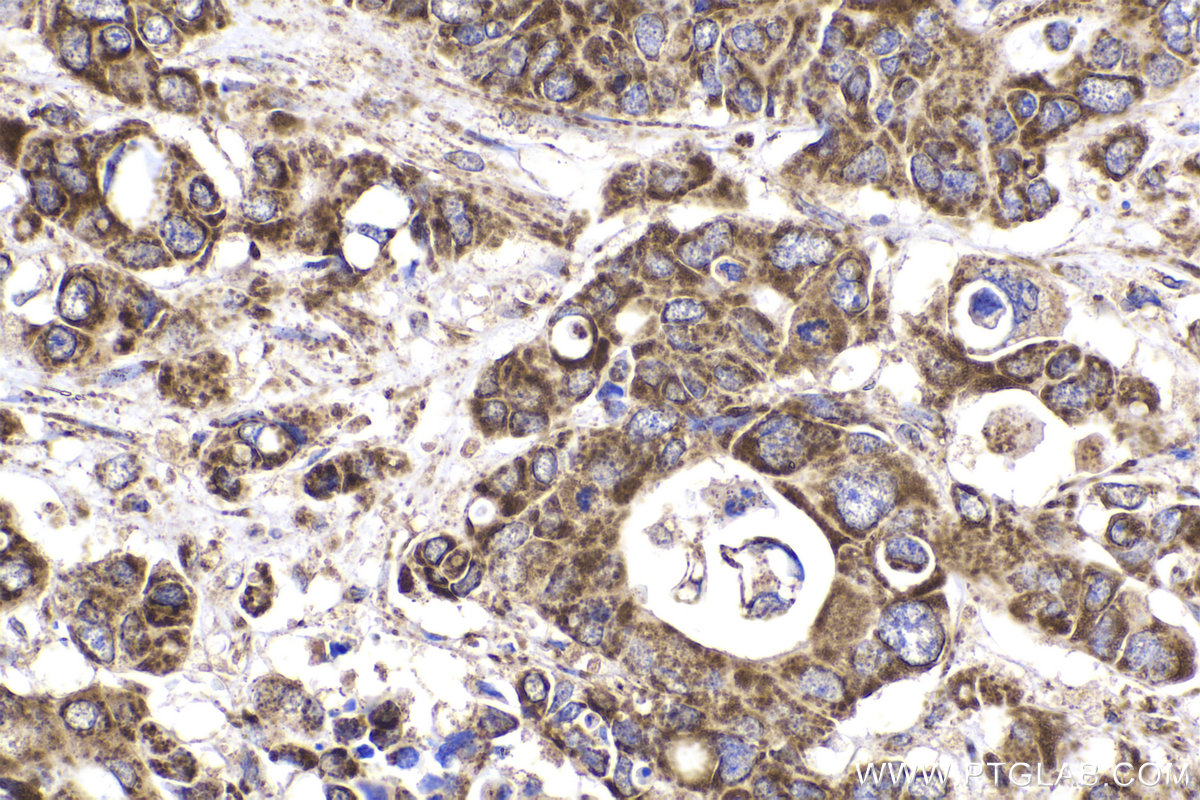 Immunohistochemical analysis of paraffin-embedded human stomach cancer tissue slide using KHC2223 (PDHA2 IHC Kit).