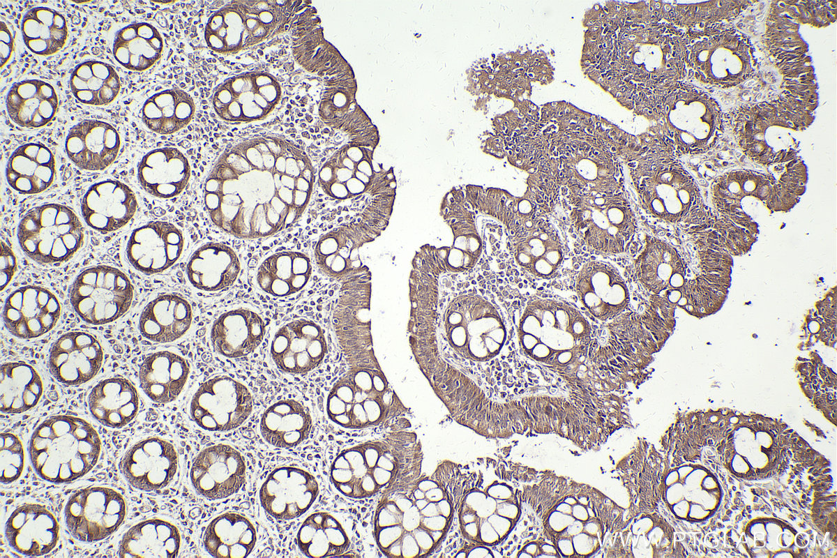 Immunohistochemical analysis of paraffin-embedded human rectal cancer tissue slide using KHC2479 (PDK2 IHC Kit).