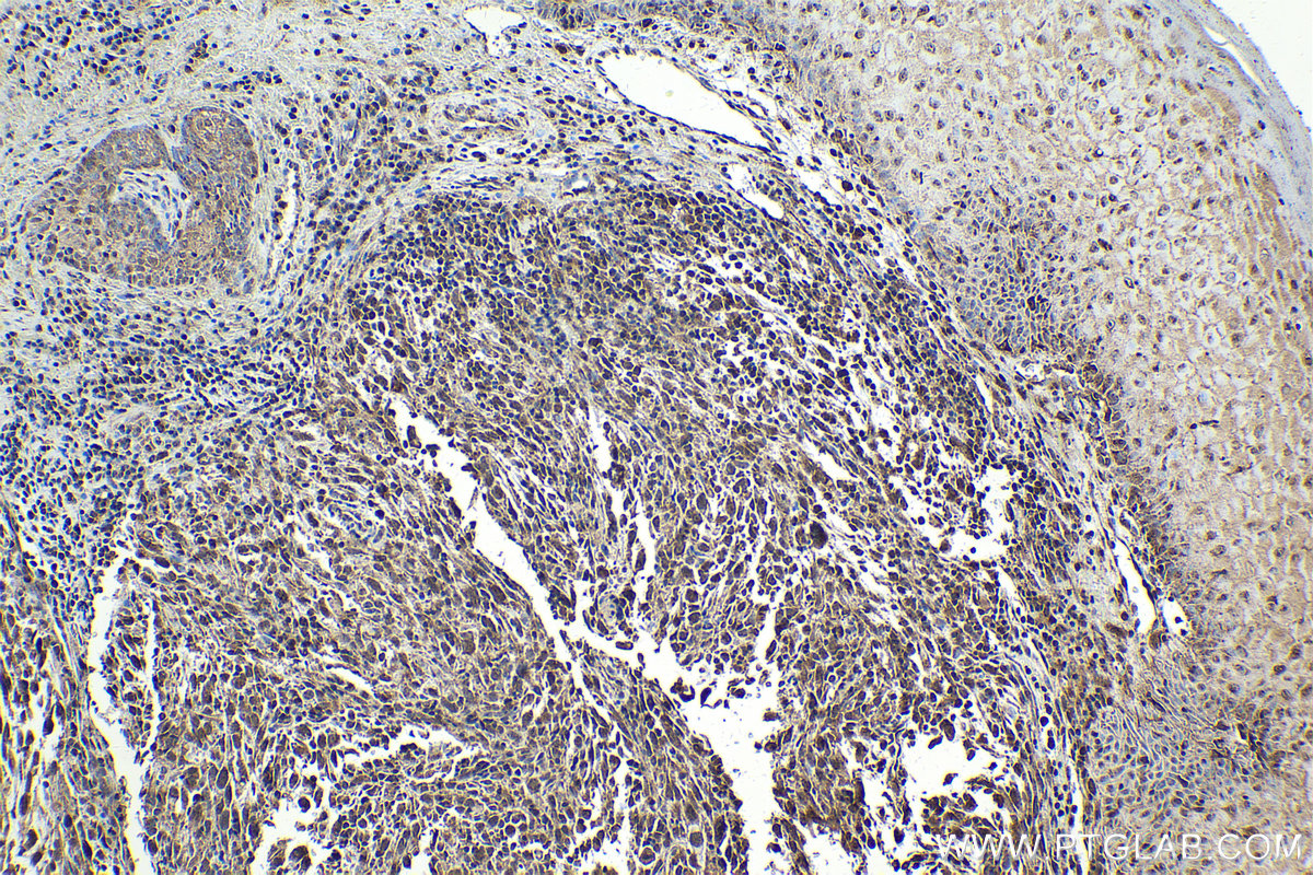 Immunohistochemical analysis of paraffin-embedded human skin cancer tissue slide using KHC2083 (PER2 IHC Kit).