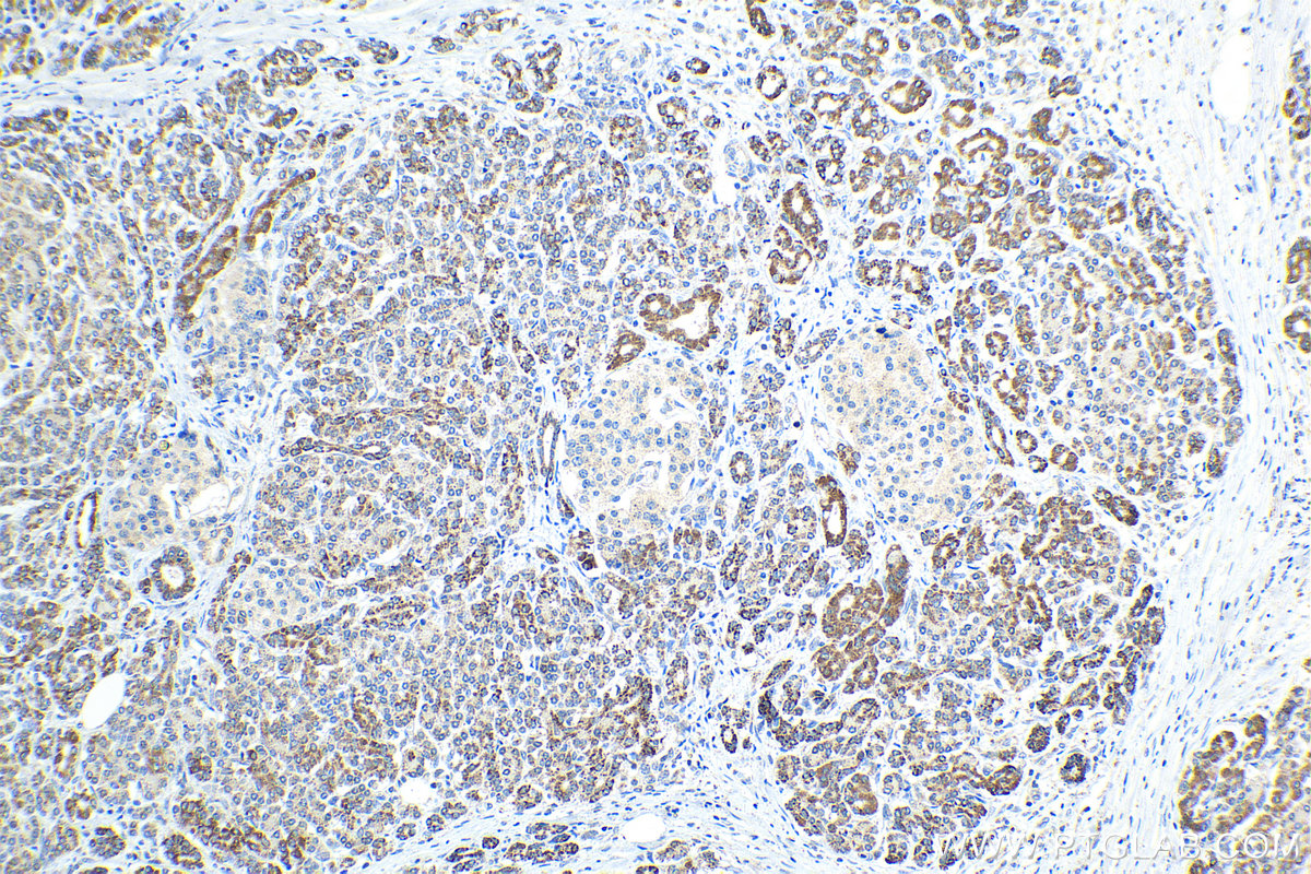 Immunohistochemical analysis of paraffin-embedded human pancreas cancer tissue slide using KHC1515 (PKHD1 IHC Kit).