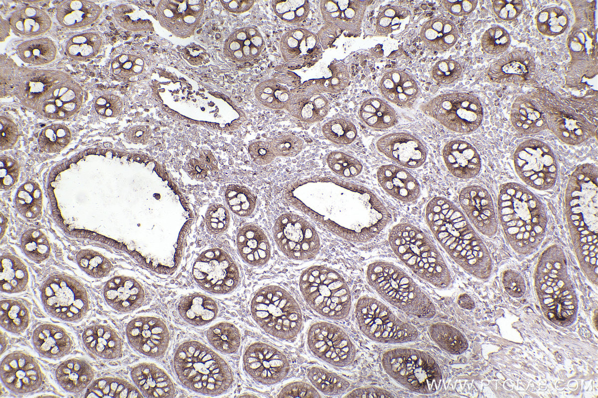 Immunohistochemical analysis of paraffin-embedded human rectal cancer tissue slide using KHC2459 (PLD1 IHC Kit).