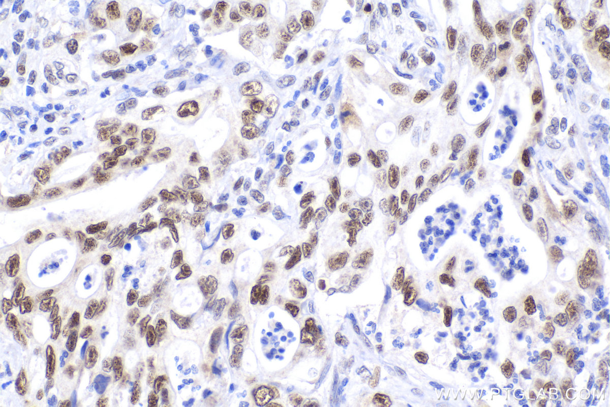 Immunohistochemical analysis of paraffin-embedded human stomach cancer tissue slide using KHC2285 (POLD2 IHC Kit).