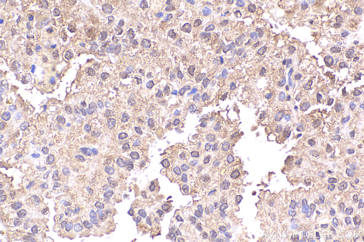 Immunohistochemical analysis of paraffin-embedded human renal cell carcinoma tissue slide using KHC2226 (PPP2R1A IHC Kit).