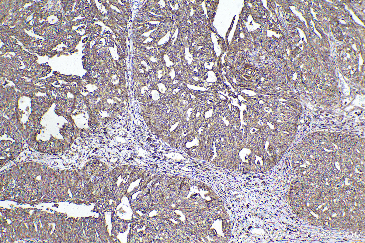 Immunohistochemical analysis of paraffin-embedded human ovary cancer tissue slide using KHC2419 (PRDX4 IHC Kit).