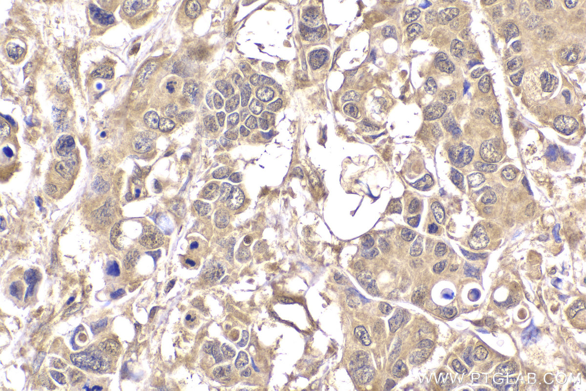 Immunohistochemical analysis of paraffin-embedded human stomach cancer tissue slide using KHC2208 (PRKACB IHC Kit).