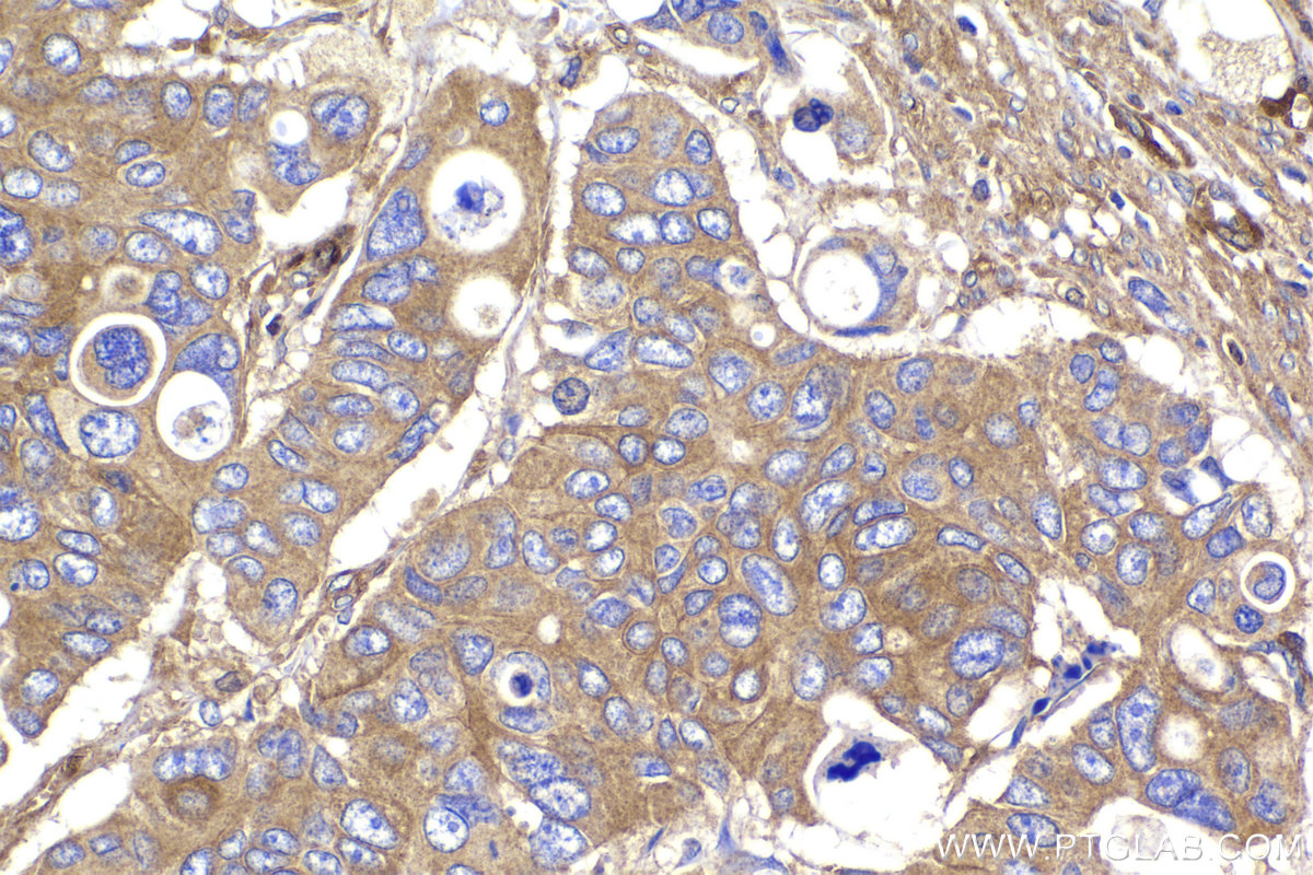 Immunohistochemical analysis of paraffin-embedded human stomach cancer tissue slide using KHC2175 (PRKAR1A IHC Kit).