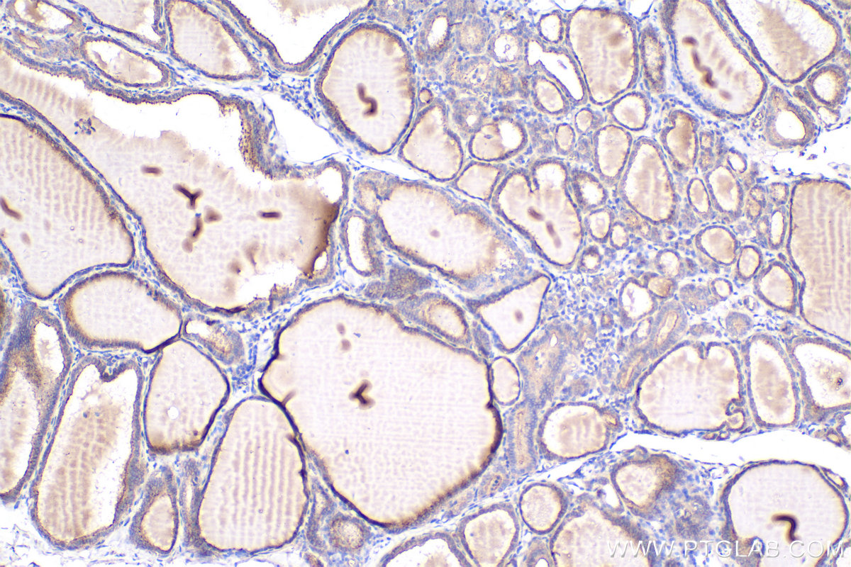 Immunohistochemical analysis of paraffin-embedded human thyroid cancer tissue slide using KHC2392 (PRKCQ IHC Kit).