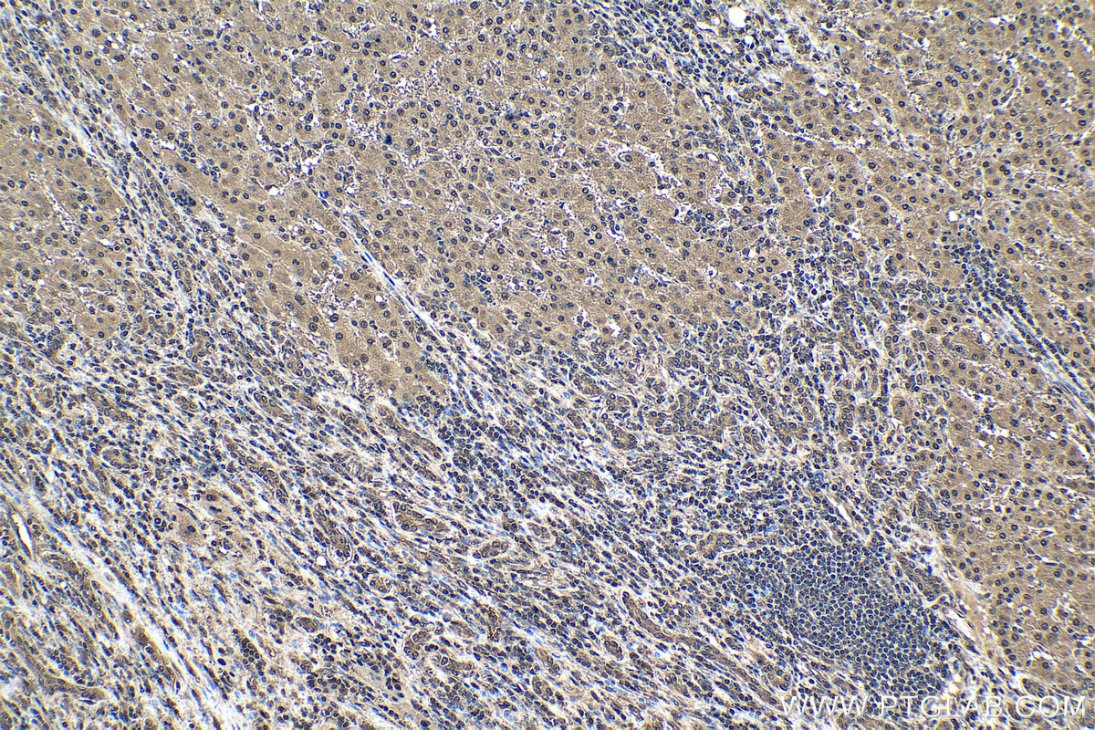 Immunohistochemical analysis of paraffin-embedded human liver cancer tissue slide using KHC1563 (PSMA3 IHC Kit).