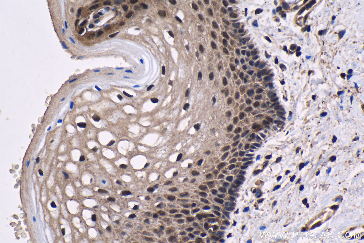 Immunohistochemical analysis of paraffin-embedded human cervical cancer tissue slide using KHC1429 (PSMA7 IHC Kit).