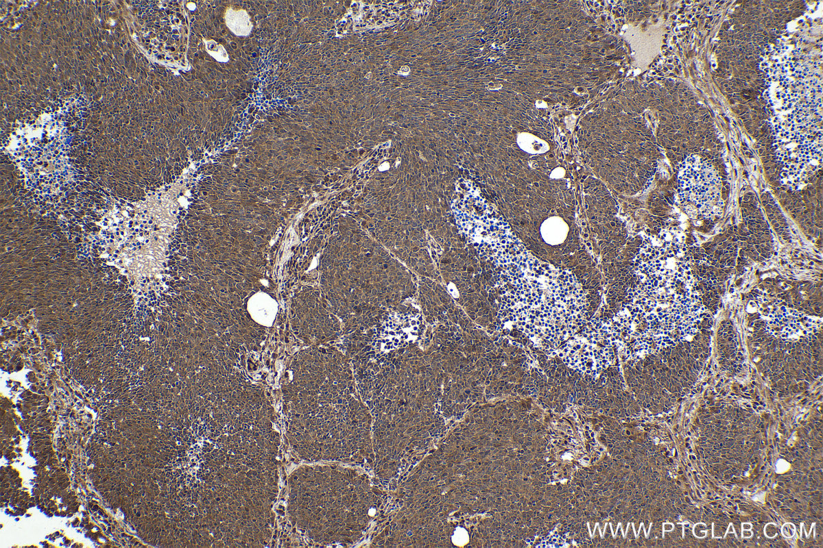 Immunohistochemical analysis of paraffin-embedded human lung cancer tissue slide using KHC2249 (PSMC2 IHC Kit).