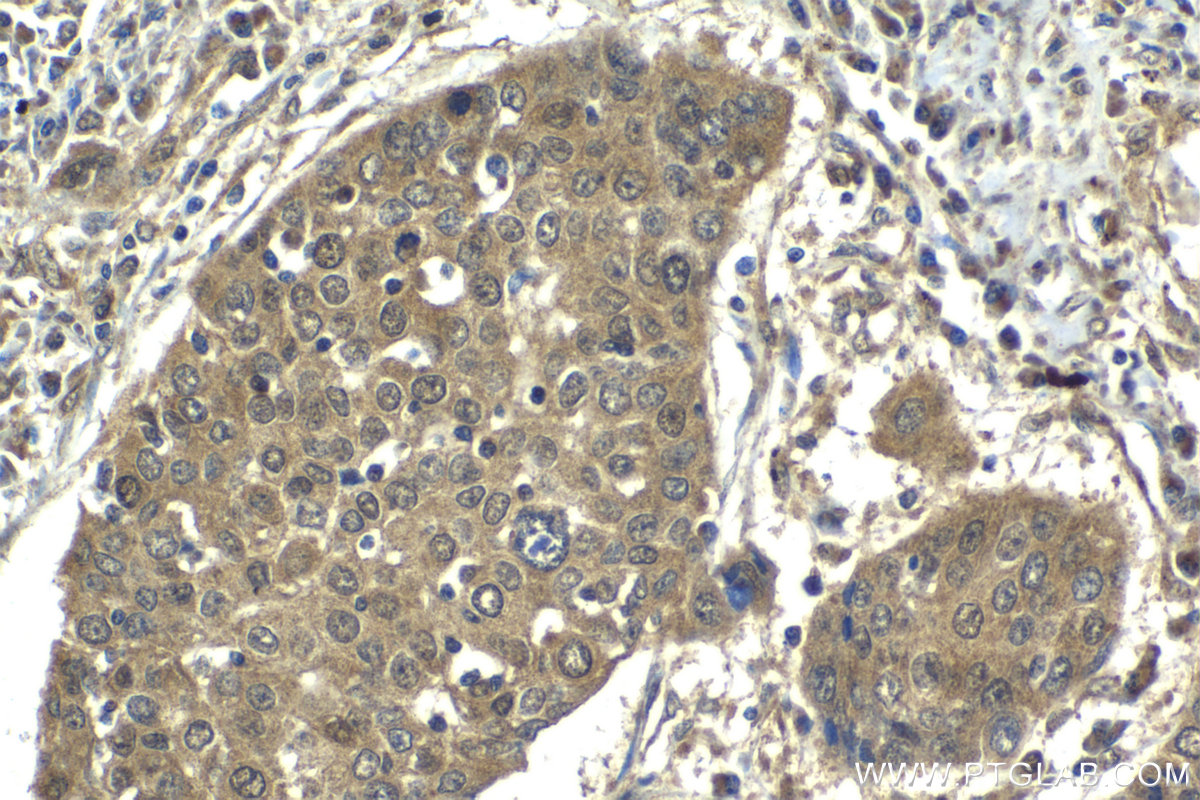 Immunohistochemical analysis of paraffin-embedded human lung cancer tissue slide using KHC2042 (PSMD12 IHC Kit).