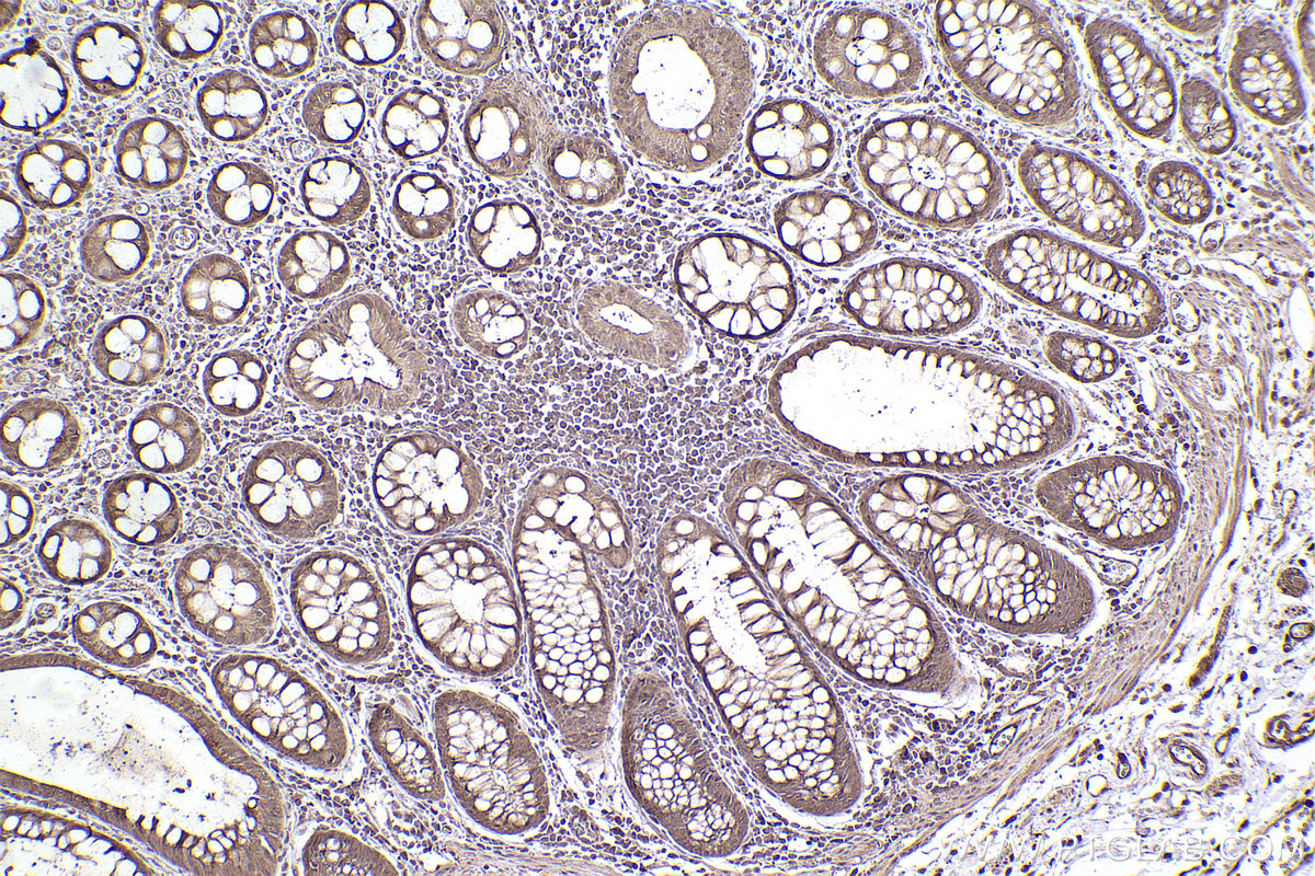 Immunohistochemical analysis of paraffin-embedded human rectal cancer tissue slide using KHC2475 (PSMD6 IHC Kit).