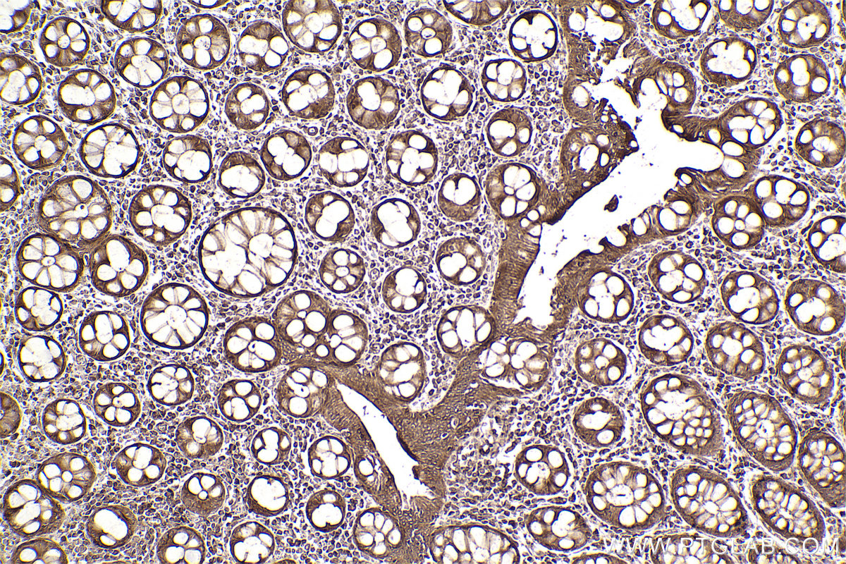 Immunohistochemical analysis of paraffin-embedded human rectal cancer tissue slide using KHC2457 (PTK2B IHC Kit).