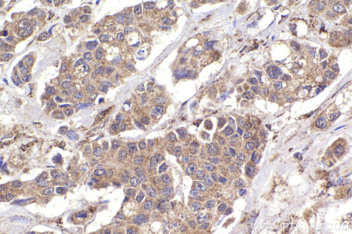 Immunohistochemical analysis of paraffin-embedded human stomach cancer tissue slide using KHC2221 (PTPN6 IHC Kit).