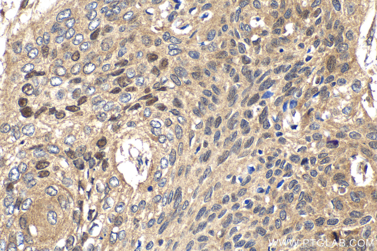 Immunohistochemical analysis of paraffin-embedded human oesophagus cancer tissue slide using KHC2152 (PTTG1/Securin IHC Kit).