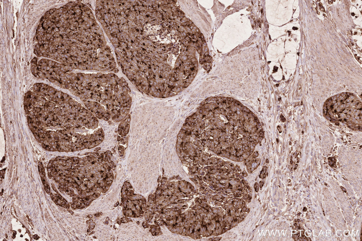 Immunohistochemical analysis of paraffin-embedded human stomach cancer tissue slide using KHC2599 (RAB11FIP1 IHC Kit).