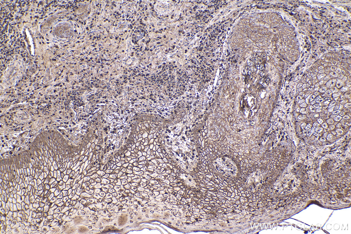 Immunohistochemical analysis of paraffin-embedded human skin cancer tissue slide using KHC2356 (RAC1 IHC Kit).