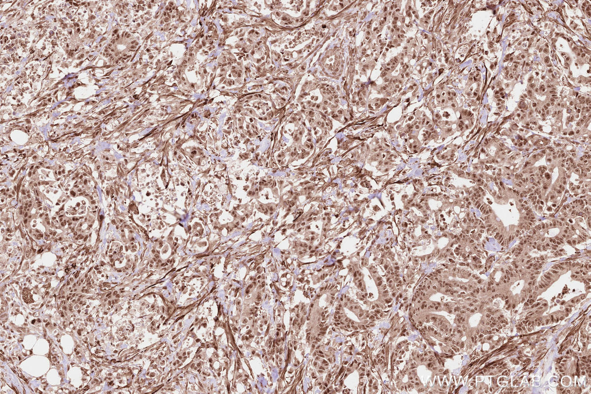 Immunohistochemical analysis of paraffin-embedded human rectal cancer tissue slide using KHC2624 (RBBP6 IHC Kit).