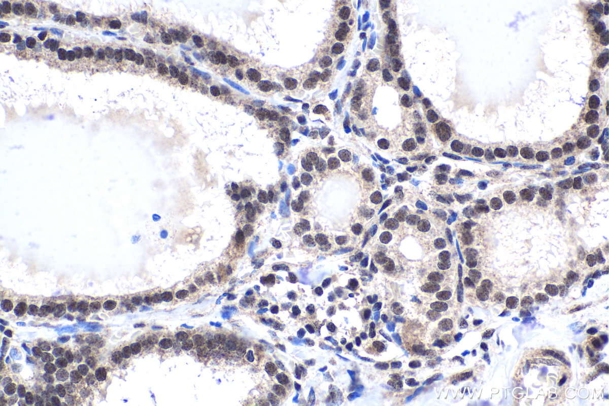 Immunohistochemical analysis of paraffin-embedded human thyroid cancer tissue slide using KHC1701 (REST IHC Kit).