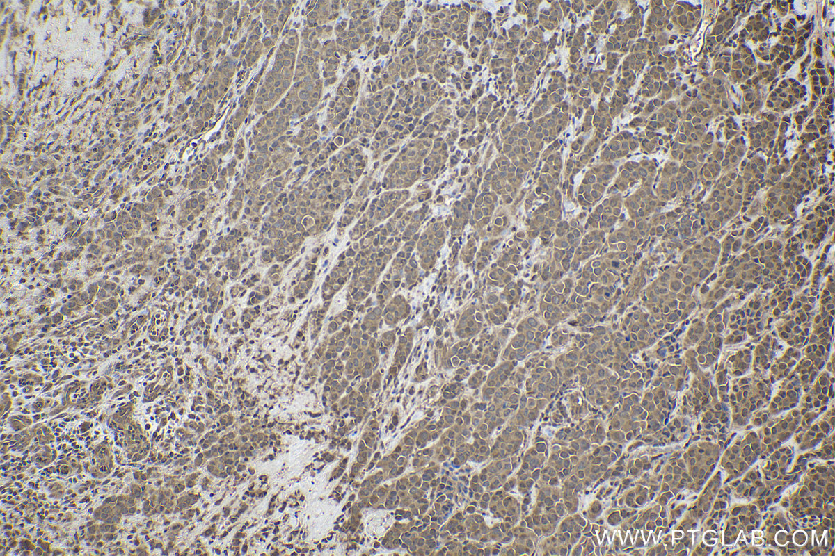 Immunohistochemical analysis of paraffin-embedded human malignant melanoma tissue slide using KHC1933 (RGC32 IHC Kit).