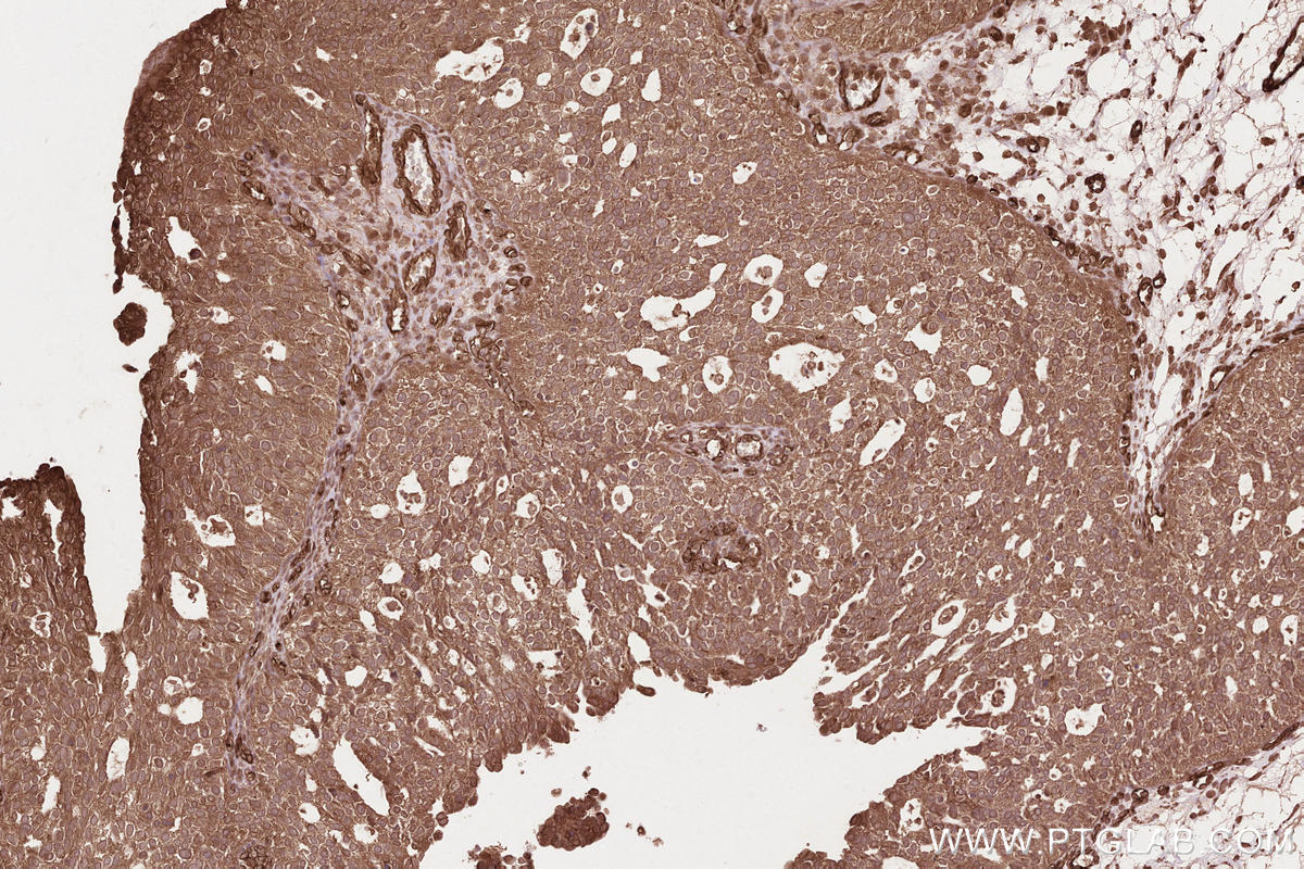 Immunohistochemical analysis of paraffin-embedded human ovary cancer tissue slide using KHC2568 (RNF213 IHC Kit).