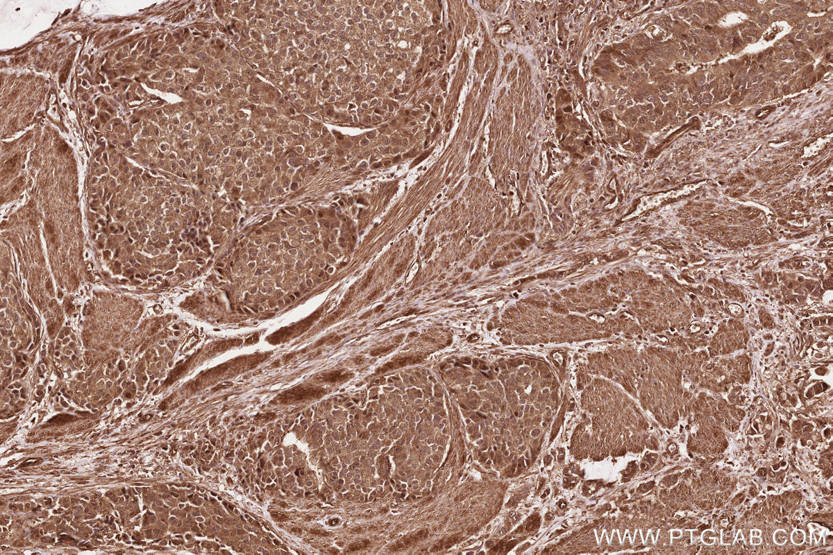 Immunohistochemical analysis of paraffin-embedded human stomach cancer tissue slide using KHC2568 (RNF213 IHC Kit).